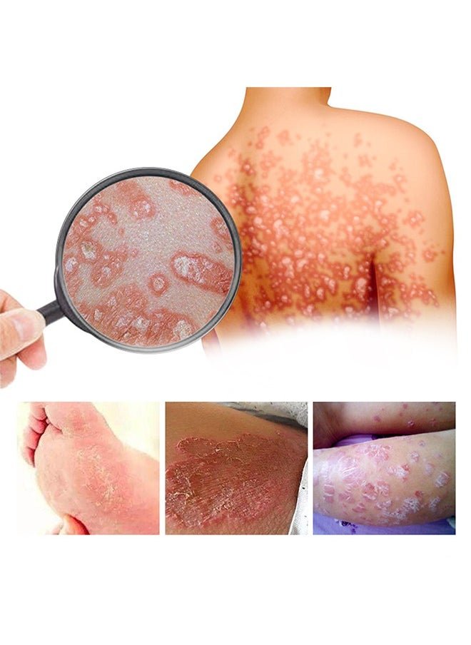 South Moon Bee Venom Psoriasis Cream for Itch & Flare-Up Relief | Natural Skin Soothing