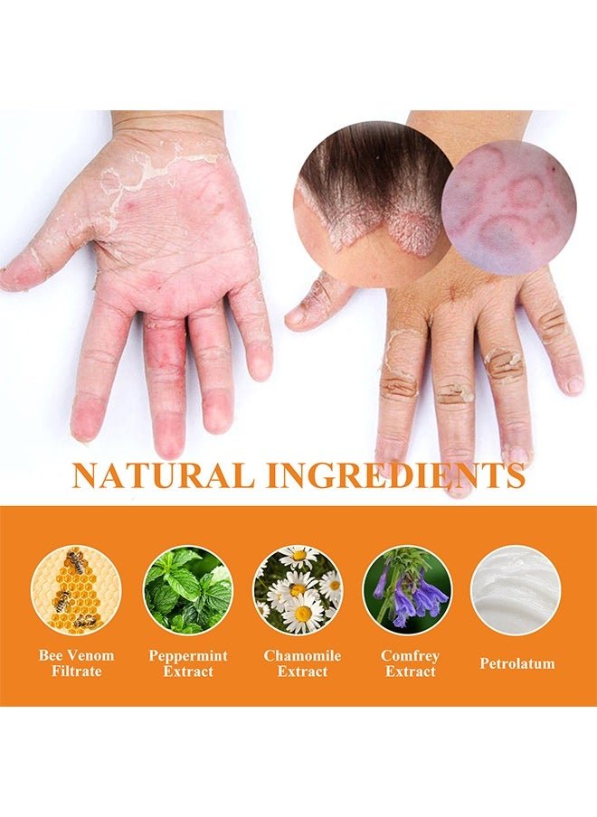 South Moon Bee Venom Psoriasis Cream for Itch & Flare-Up Relief | Natural Skin Soothing