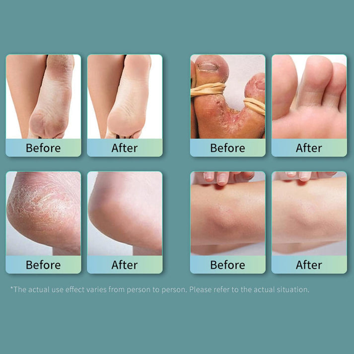 🔥Ansiyi Original Foot Spray – Antibacterial, Anti-Fungal, Odor Removal & Bacteriostasis Protection