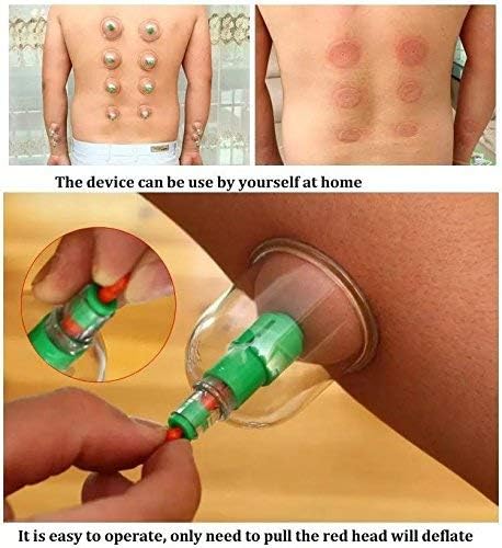 KN Vacuum Therapy Cup